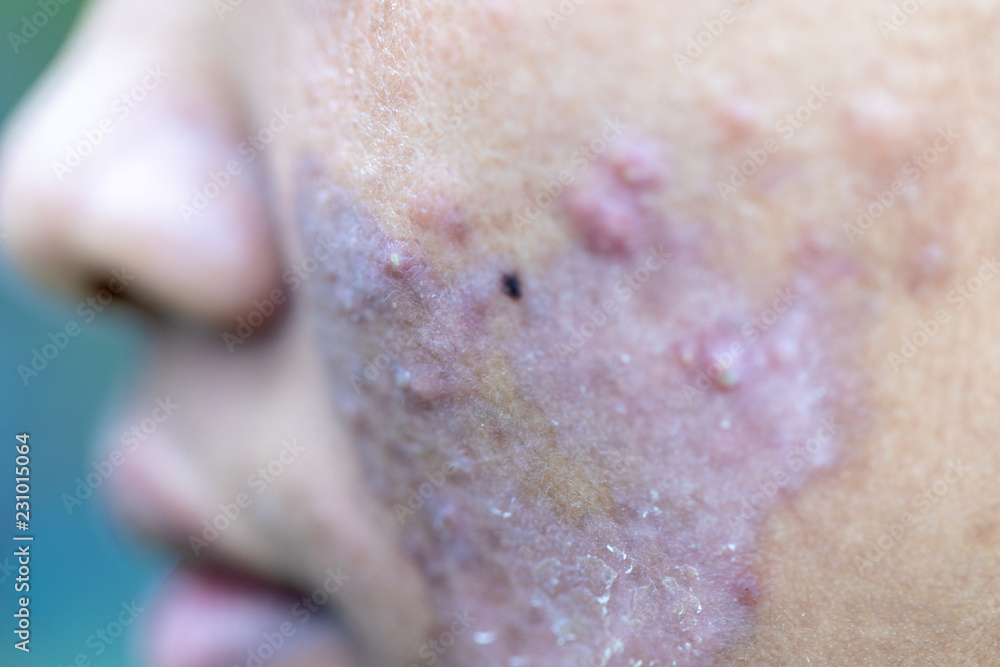 Fototapeta premium Backgrounds of lesions skin caused by acne on the face in the clinic.