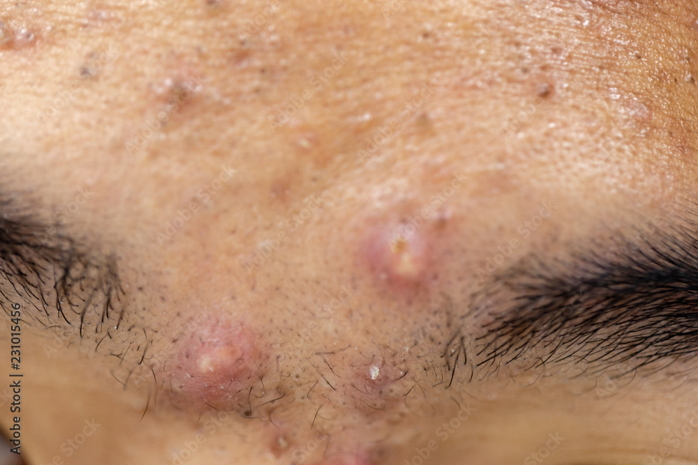 Fototapeta premium Backgrounds of lesions skin caused by acne on the face in the clinic.
