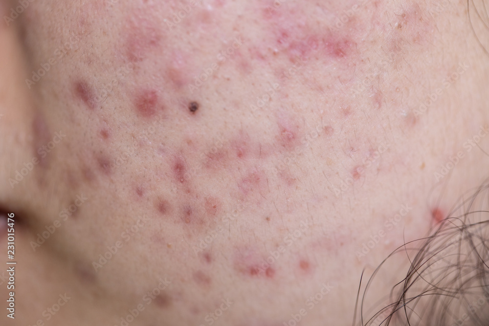 Backgrounds of lesions skin caused by acne on the face in the clinic. Backgrounds of lesions skin caused by acne on the face in the clinic.