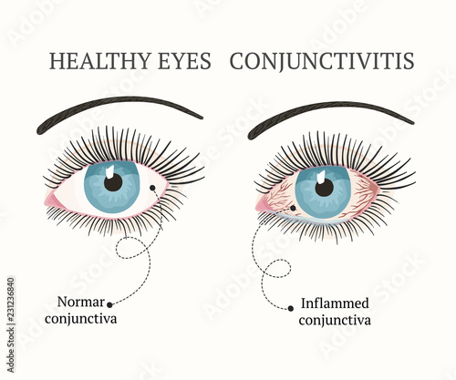 Eye disease. Ophthalmology health illustration.