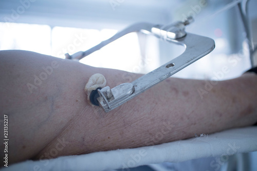 Fixation of the Ilizarov apparatus on the shins at the end of the operation, metal construction on the patient's leg photo