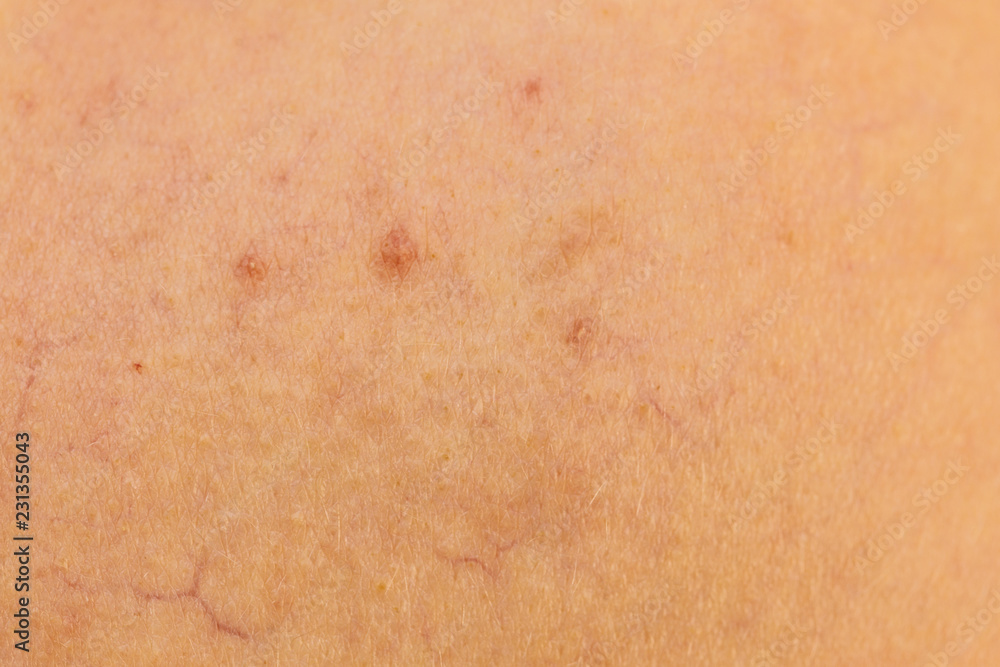 Ski with dilated capillaries ad red spots Ski with dilated capillaries ad red spots