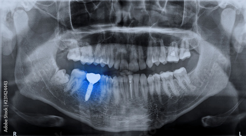 Panoramic dental x-ray image mouth of adult man and single dental implant with crown attached used for tooth replacement, with indicated with treatment area photo