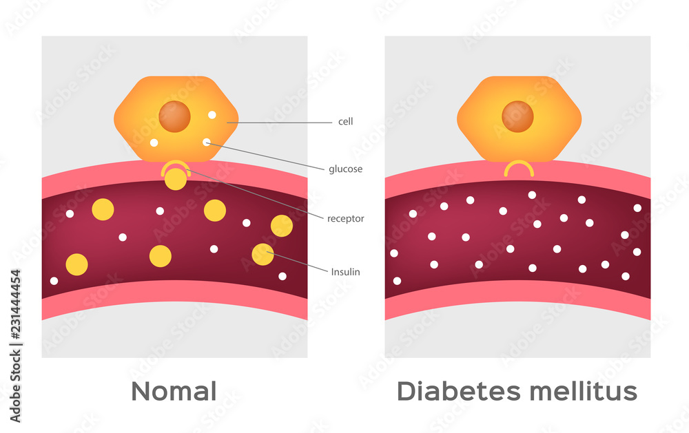 Insulin type / normal physiology , diabetes / unlocks the cell's glucose  channel animation graphic Stock Vector | Adobe Stock