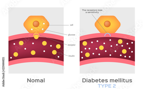 Insulin type / normal physiology , diabetes / unlocks the cell's glucose channel animation graphic