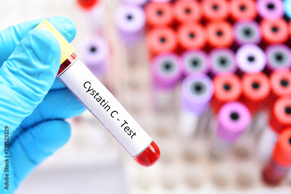 Obraz premium Blood sample tube for cystatin C test, diagnosis for renal disease