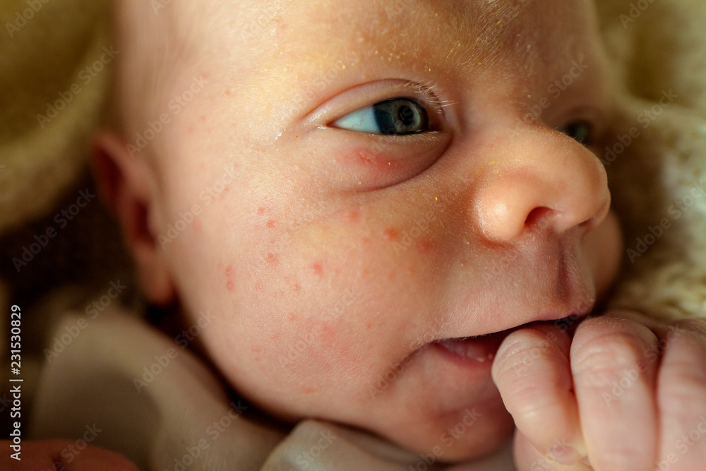 Allergy in face newborn baby boy Allergy in face newborn baby boy