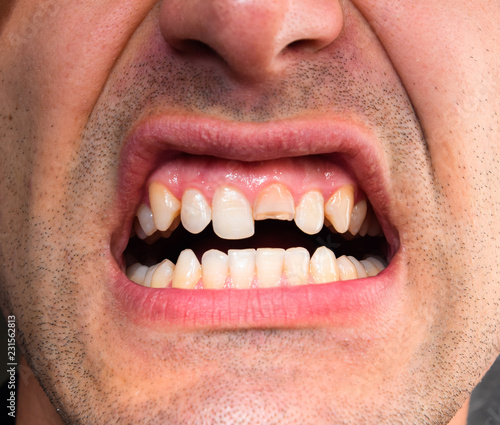 Broken tooth. Broken upper incisor in a man mouth. Man shows oral cavity to the dentist. Treatment of a broken tooth.