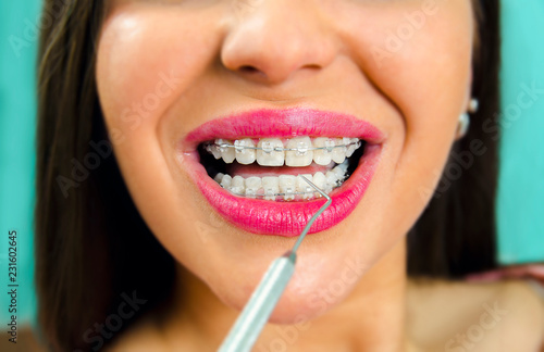 Closeup dental braces check up, young woman smiling with braces in dental clinic 