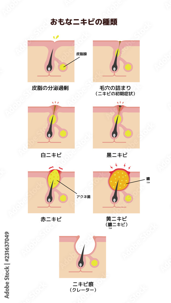 おもなニキビの種類と症状 イラスト 日本語 Stock ベクター Adobe Stock
