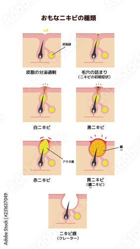 おもなニキビの種類と症状　イラスト(日本語)