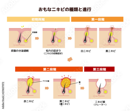 おもなニキビの種類と症状の進行　イラスト(日本語)