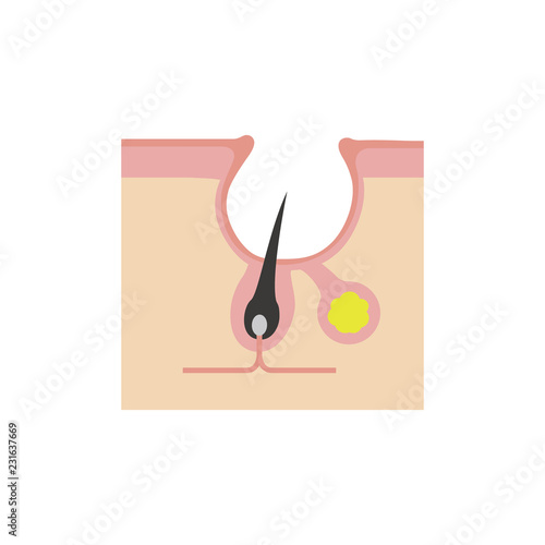 Cross section of pores ( acne progression) / Acne scar ( crater)