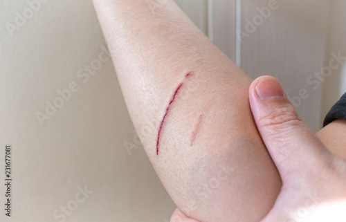 Fresh Wound of Deep Skin Scratch on the Forearm .