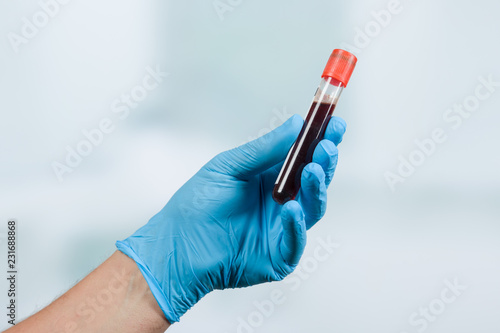 Hand mit medizinischem Handschuh hält eine Blutprobe