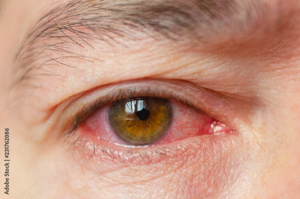 Naklejka premium Closeup irritated infected red bloodshot eyes, conjunctivitis