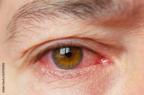 Closeup irritated infected red bloodshot eyes, conjunctivitis photo