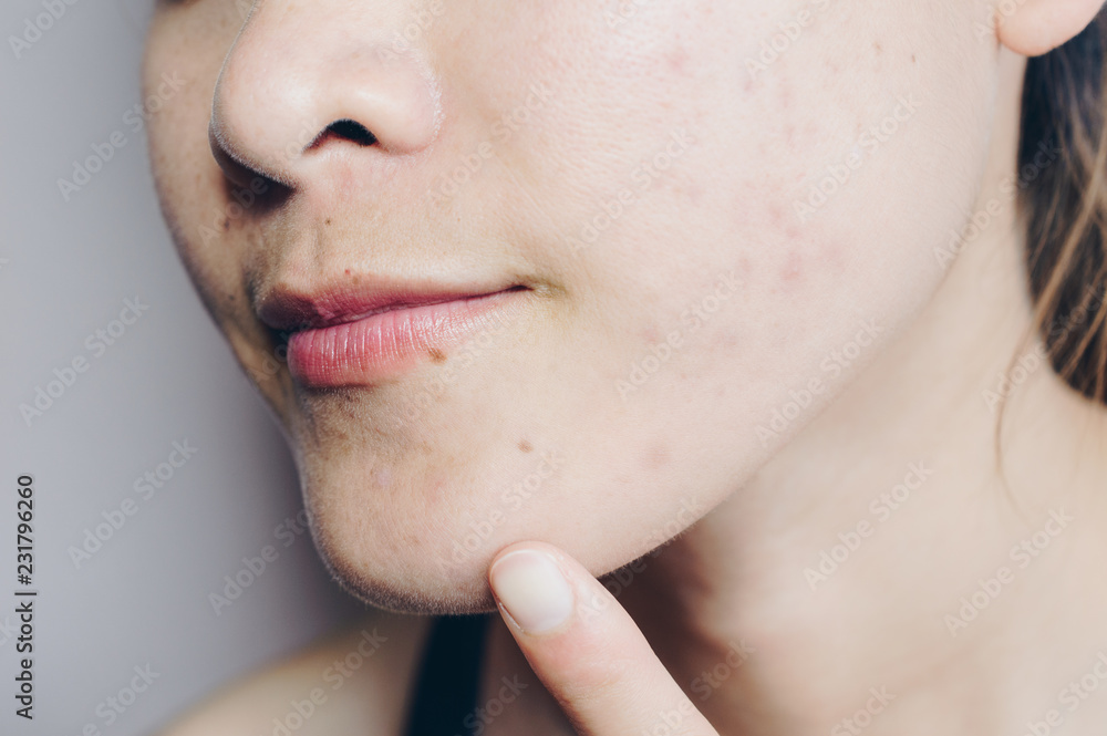 Obraz premium Close-up of Asian woman has problems with skin on her face. Problems with acne and scar on the female skin.