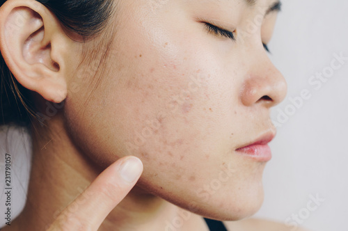 Asian woman has acne problems on her face. photo
