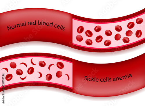 Comparison between normal red blood cells and sickle cells anemia in blood vessel