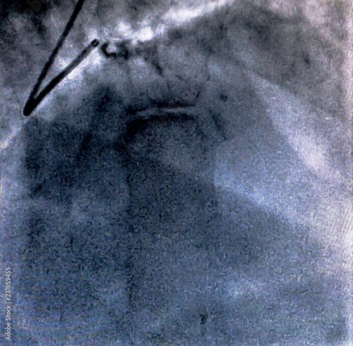 Catheterization. Cardiac ventriculography, cardiogram, is a medical imaging test used to determine a patient cardiac function in the right or left ventricle photo