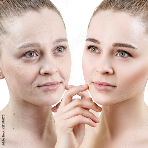 Portrait of woman before and after skin rejuvenation.