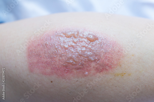 Red blisters and red blisters are caused by hot water blisters.