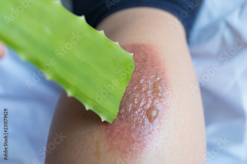 Aloe vera treatment in the blisters caused by a fire.