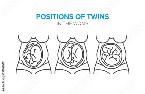 position of twins in the womb