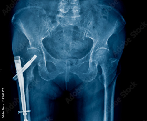 Foto hip fixation for old patient with hip fracture