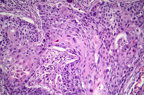 Squamous cell carcinoma of the lung photo