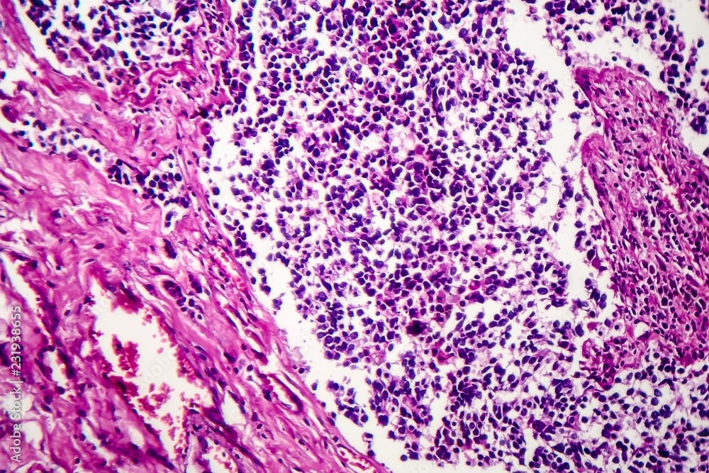 Obraz premium Small cell lung cancer