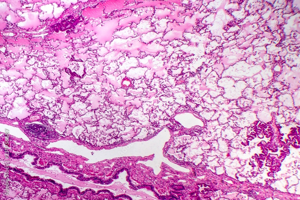 Fototapeta premium Lung adenocarcinoma