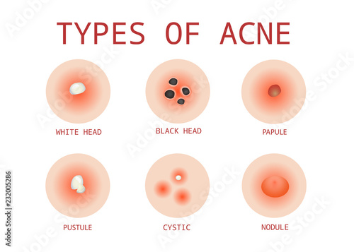 6 Types of Acne, Vector