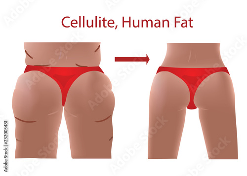 Fat female body with cellulite, Human Fat, Before and After with Fit body, vector