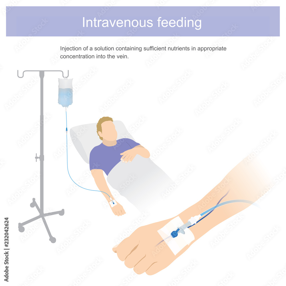 Injection of solution containing sufficient nutrient in appropriate concentration into the vein. Illustration graphic. Injection of solution containing sufficient nutrient in appropriate concentration into the vein. Illustration graphic.