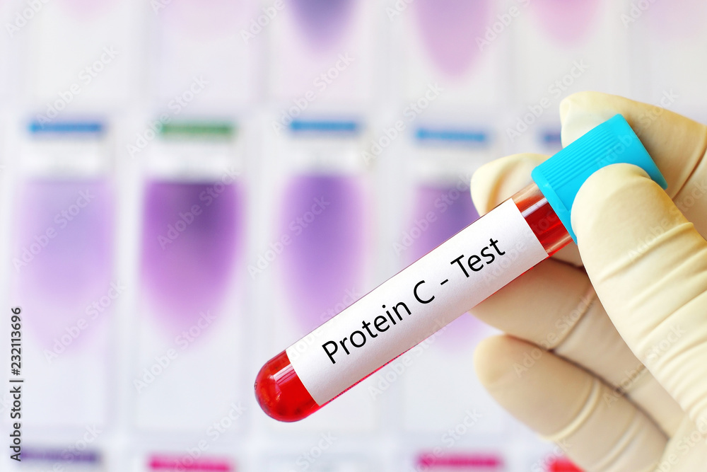 Fototapeta premium Test tube with blood sample for protein C test, coagulation disorder diagnosis