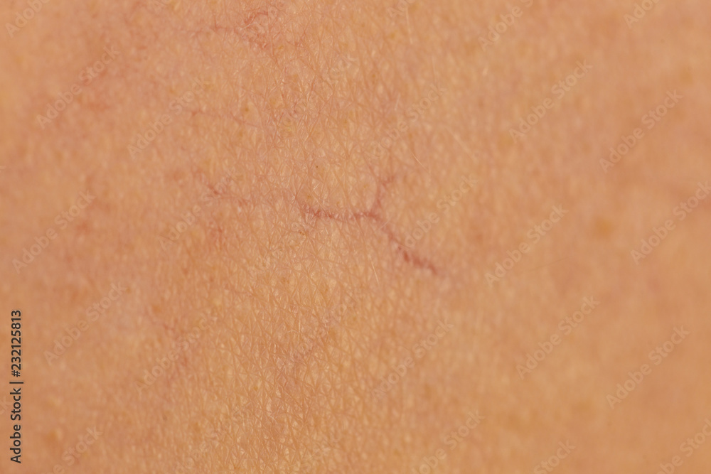 Ski with dilated capillaries ad red spots Ski with dilated capillaries ad red spots