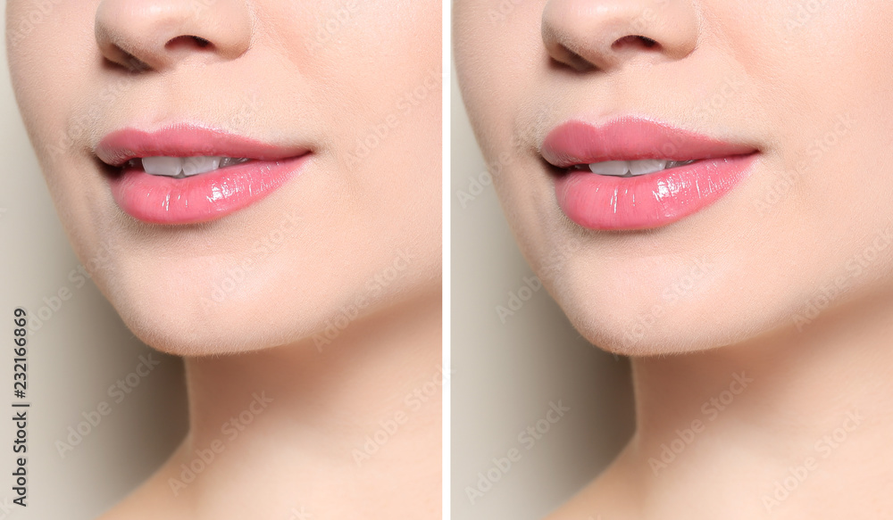 Naklejka premium Woman before and after lips augmentation procedure, closeup. Cosmetic surgery