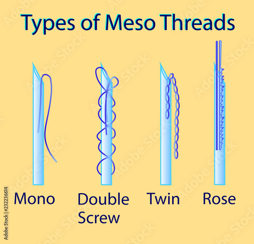 Vector illustration with types of meso threads