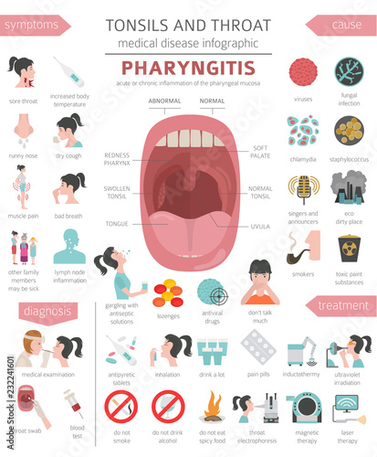 Tonsils and throat diseases. Pharyngitis symptoms, treatment icon set. Medical infographic design