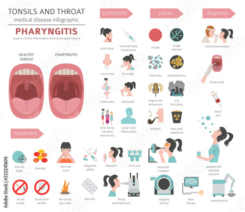 Tonsils and throat diseases. Pharyngitis symptoms, treatment icon set. Medical infographic design