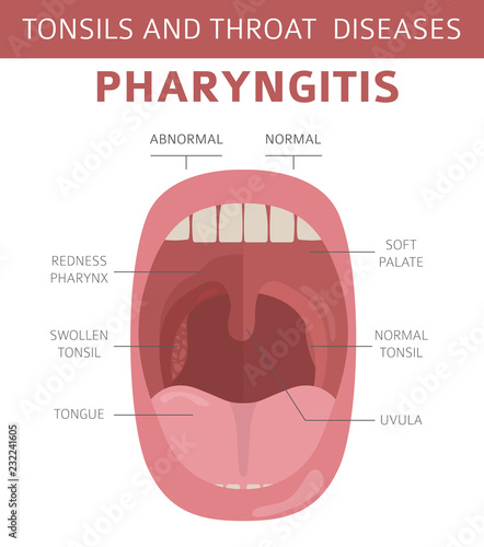 Tonsils and throat diseases. Pharyngitis symptoms, treatment icon set. Medical infographic design photo