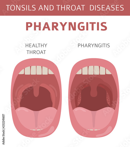 Tonsils and throat diseases. Pharyngitis symptoms, treatment icon set. Medical infographic design