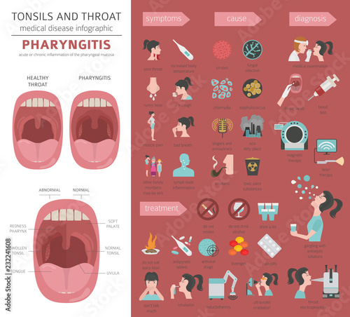 Tonsils and throat diseases. Pharyngitis symptoms, treatment icon set. Medical infographic design