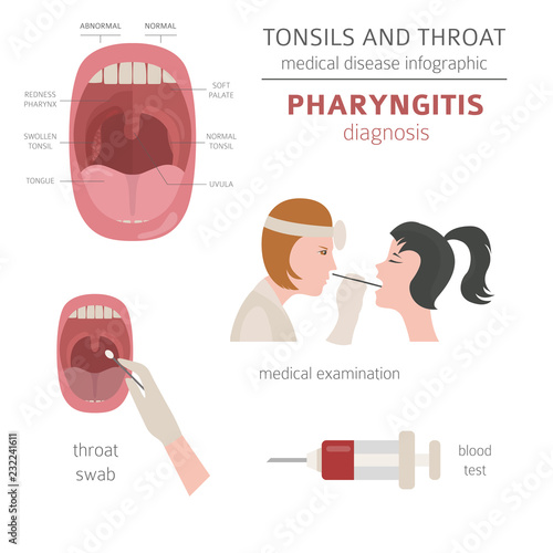 Tonsils and throat diseases. Pharyngitis symptoms, treatment icon set. Medical infographic design