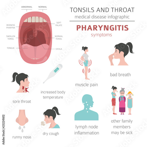 Tonsils and throat diseases. Pharyngitis symptoms, treatment icon set. Medical infographic design