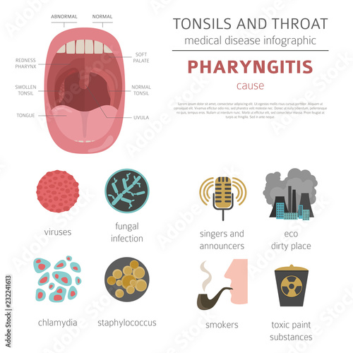 Tonsils and throat diseases. Pharyngitis symptoms, treatment icon set. Medical infographic design
