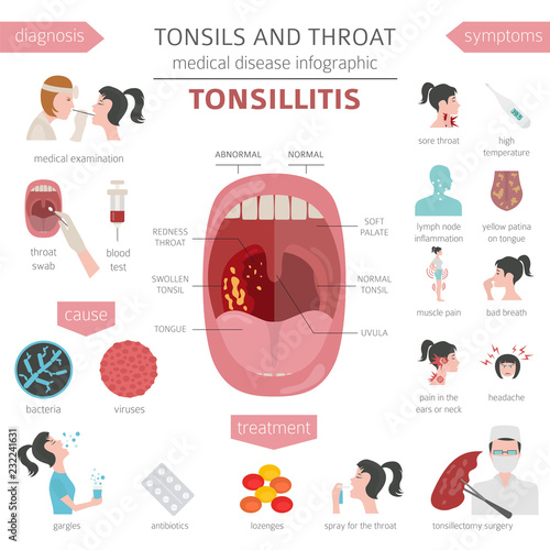 Tonsils and throat diseases. Tonsillitis symptoms, treatment icon set. Medical infographic design