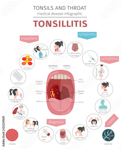 Tonsils and throat diseases. Tonsillitis symptoms, treatment icon set. Medical infographic design
